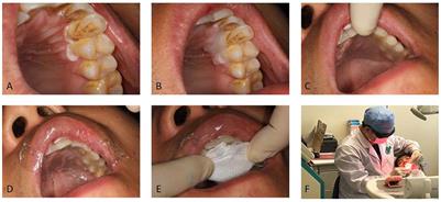 Primary Clinical Evaluation of Photodynamic Therapy With Oral Leukoplakia in Chinese Patients